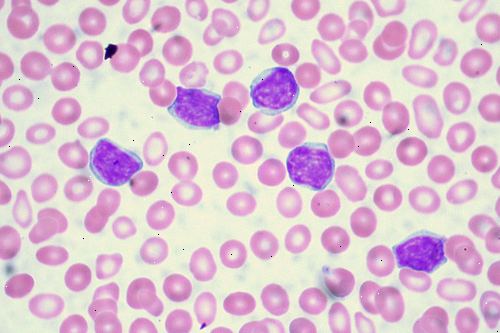 Sin síntomas, 90% de personas con leucemia linfática crónica