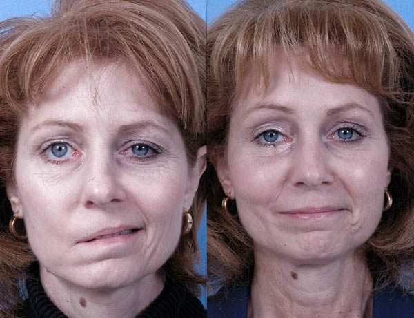 Golpes, infección y cambios de temperatura, causas de parálisis facial