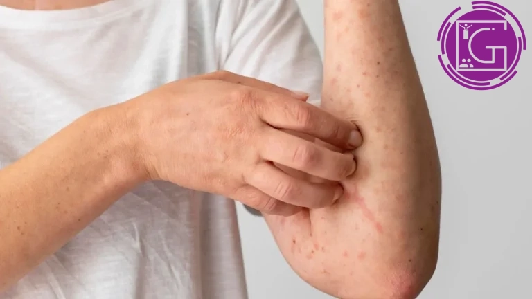 Refuerza Salud vigilancia y vacunación ante casos de sarampión en Querétaro